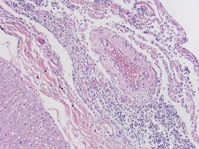 Fig. 23.17, Microscopically, in early stages, the leptomeningeal inflammation in acute bacterial meningitis may surround leptomeningeal vessels without adversely affecting them (compare with Fig. 23.18 ).