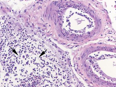 Fig. 23.18, The exudate in this case of bacterial meningitis contains numerous polymorphonuclear leukocytes (PMNs), a few admixed larger mononuclear cells, and protein threads (arrows); at this stage a secondary vasculitis “from the outside in” may occur, as in the two leptomeningeal vessels shown here.