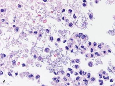 Fig. 23.19, (A) This patient succumbed to E. coli meningitis and ventriculitis; massive numbers of bacteria were found in his ventriculitis sites at autopsy; the overwhelming numbers can be attributed to additional postmortem bacterial overgrowth in deep brain areas relatively untouched by immersion formalin fixation. (B) Collections of epithelioid histiocytes, multinucleated giant cells, and caseating necrosis are seen in cases of tuberculous meningitis. (C) Tuberculous bacteria are not visible on H & E and require Ziehl-Neelsen histochemical staining. (D) Tuberculous meningitis can be associated with secondary vascular damage and secondary vasculitis, as seen here.