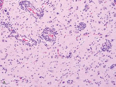 Fig. 23.20, (A) Neurosyphilis is characterized by meningeal and perivascular mononuclear cells, neuronal injury and loss, intense gliosis, and diffusely distributed individual microglial cells. The latter are classically arranged in an “upright” fashion perpendicular to the pial surface and are called “rod cells.” (B) One of the histologic clues to a diagnosis of neurosyphilis is the profuse numbers of plasma cells. This case came from a 30-year-old man with no past medical history who presented with 2 weeks of headache and was found to have a 19-mm oval mass in the right parietal lobe involving the cortex and subcortical white matter with surrounding edema, consistent with a necrotic “gumma.” CSF demonstrated lymphocytic pleocytosis. (C) Treponema pallidum may be very difficult to identify on histochemical stains or immunohistochemical stains in some cases of neurosyphilis, but numerous immunopositive organisms were found in this case of “gumma” with central necrosis. (D) Pachymeningitis can be seen with infection by T. pallidum. (All neurosyphilis images courtesy of Dr. Arie Perry.)