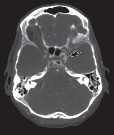 Fig. 23.2, Computerized tomographic (CT) angiogram, axial, showing proximal left internal carotid artery occlusion (arrow) caused by Mucorales species infection in a patient with two risk factors: diabetes mellitus and unsuspected primary hemochromatosis with micronodular cirrhosis discovered at autopsy. He presented originally with ear infection and sinusitis and was treated as an outpatient with antibiotics until development of left-sided facial droop, dysarthria, and gait instability. His severe cerebral edema necessitated transfer to a tertiary facility, placement of an external ventricular drain, and mannitol and hypertonic saline therapies, as well as unsuccessful right-sided decompressive craniectomy and lobectomy, prior to demise.