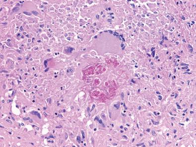 Fig. 23.22, C. immitis meningitis is often seen in immunocompetent hosts who live in geographically endemic regions, such as the southwestern United States; meninges can show multinucleated giant cells engulfing the organism, as highlighted here on periodic acid–Schiff stain.