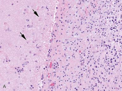 Fig. 23.23, (A) Meningitis due to C. neoformans can be devoid of any inflammation by the host if there is severe immunocompromise and very low T cell counts, as in AIDS patients. Biopsy specimens from treated patients, as seen here from a 45-year-old male with possible lapse in drug compliance, may show meningeal macrophages stuffed with organisms; note the underlying gliosis in the molecular layer (arrows) and relatively scant meningeal lymphocytes, plasma cells, and monocytes. (B) Fungal organisms in treated cryptococcal meningitis may be engulfed by macrophages but are still highlighted by periodic acid–Schiff (PAS). (C) Grocott methenamine silver (GMS) in this same case of cryptococcal infection shown in A and B, but seen at lower magnification better reveals the massive numbers of fungi that still remain. In GMS histochemical stains, note that lipofuscin in cells in underlying brain tissue can also take up stain (at left) and should not be misconstrued as infectious particles. (D) Although the overall size is similar to that of cryptococcus, B. dermatitidis can be distinguished by its visible nucleus, as is evident from this patient's cerebellar resection specimen.