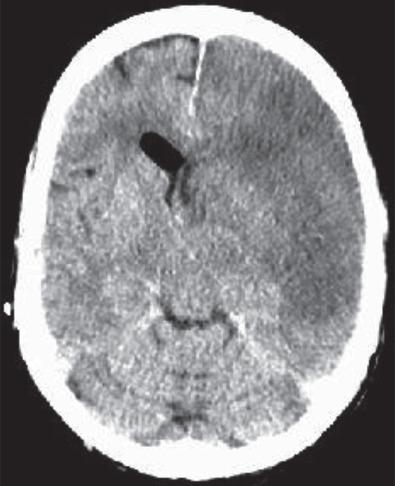 Fig. 23.3, CT axial image shows a massive acute right-sided cerebral infarct due to the occlusion of the right internal carotid artery, as seen in the angiogram in Fig. 23.2 from a patient with Mucorales species infection.