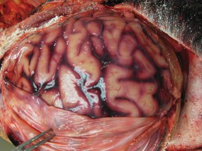 Fig. 23.4, Bacterial meningitis is seen in a 36-year-old pregnant woman with untreated sinus infection who rapidly developed changes in mental status and respiratory distress. She was diagnosed premortem as having a right internal jugular vein thrombosis. Fusobacterium necrophorum bacteremia and meningitis were culture-proven, consistent with an atypical but aggressive presentation of Lemierre syndrome. The latter is a very rare condition that usually presents with pharyngitis, but the initial presentation may be sinusitis, as it was in this patient; the infection eventually infiltrates the jugular vein, causes septic thrombus formation, and bacteremic seeding of multiple organs. Note the severe edema and hyperemia over the convexity of the brain.