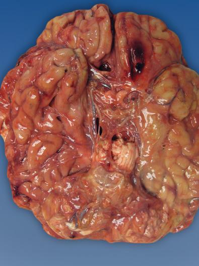 Fig. 23.5, The base of the brain from the same patient with bacterial meningitis shown in Fig. 23.4 shows even more obvious opacification of basilar leptomeninges.