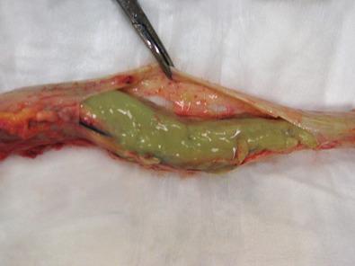 Fig. 23.6, The most dramatic purulent exudate, however, in this same patient with Fusobacterium necrophorum meningitis shown in Figs. 23.4 and 23.5 , was seen over the dorsum of the spinal cord where a thick greenish exudate obscures and obliterates all spinal cord architectural features. Such cases underscore the necessity of evaluating all meningeal compartments, including spinal cord, in cases of suspected meningitis.