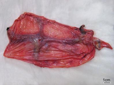 Fig. 23.7, Massive dural venous sinus thrombosis at the confluence of the sinuses was found at autopsy in this patient with F. necrophorum bacteremia and meningitis; dural venous sinus thromboses can be seen with otitis media, sinusitis, or other paranasal infections, with or without associated dehydration.