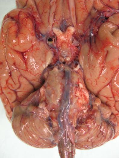 Fig. 23.9, There is a misconception that basilar meningitis is confined to patients with fungal or tubercular meningitis, when in fact, it can occur in cases where the bacterial source of the infection is paranasal (i.e., more adjacent to basilar regions) or can develop in later stages of partially treated bacterial meningitis. This patient had E. coli meningitis; the purulent exudate was particularly identified in basilar regions and obscures basis pontis architecture.