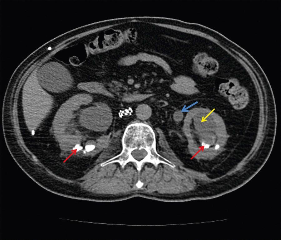 FIG. 309.1, Unenhanced computed tomography scan of the abdomen in a spinal cord–injured patient with a chronic indwelling bladder catheter and repeated episodes of upper and lower urinary tract infection due to Proteus mirabilis.