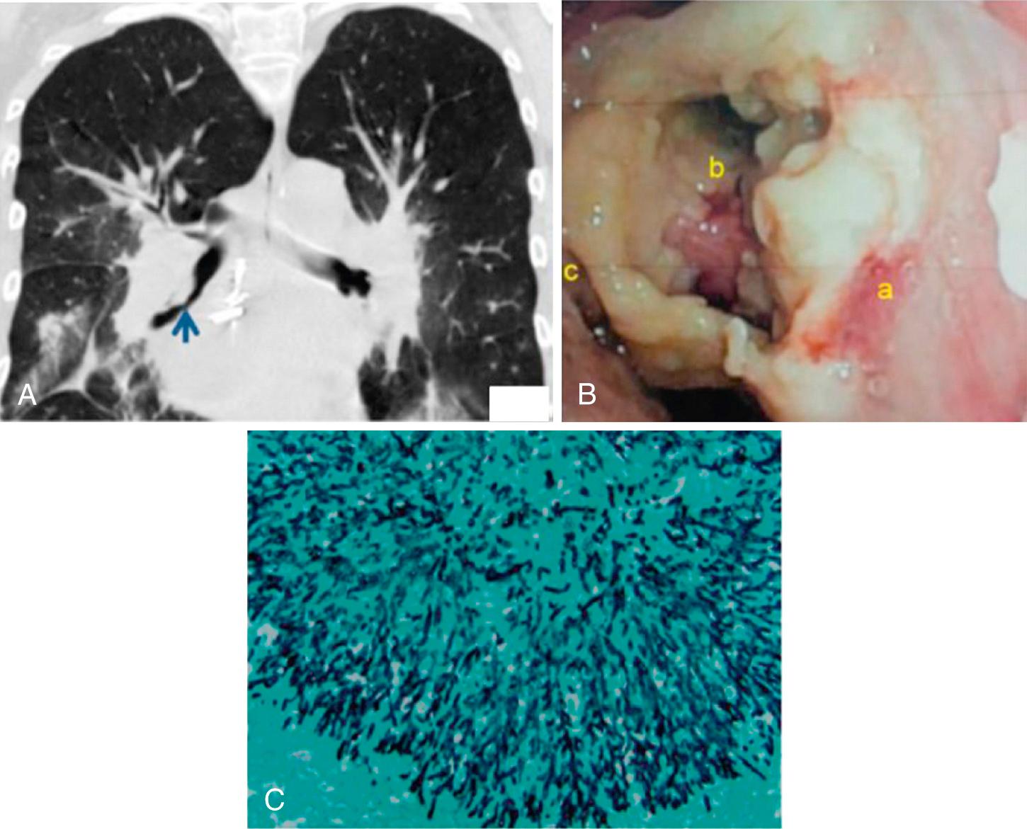 FIG. 308.3, A unique form of aspergillosis involving the airway mucosa or bronchial anastomotic sites, called tracheobronchial aspergillosis, is observed almost exclusively in lung and heart-lung recipients. (A) Coronal view showing an endobronchial lesion partially obstructing the bronchus intermedius (blue arrow) . (B) Bronchoscopy of the left allograft bronchus showing showed irregular lesions comprised of yellowish pseudomembranes mixed with necrotic debris that completely occluded the entrance into the left upper lobe and lingula. Note the presence of ulcerative lesions (e.g., “a” with shallow erythematous base, “b” with deep ulcer and bleeding crater, and “c” with necrotic ulcer), which are characteristic features of ulcerative bronchitis. (C) Histopathology and Grocott-Gomori methenamine silver stain of biopsy specimen of the lesions in B demonstrating numerous fungal forms consistent with Aspergillus species.