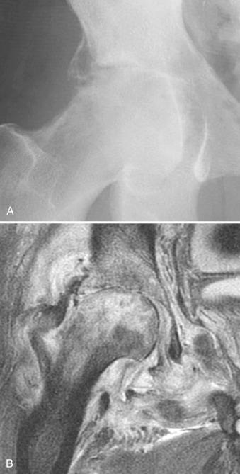 Figure 15.1, Septic arthritis of the hip joint.