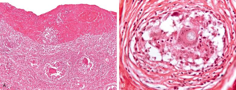 Figure 15.11, Cryptococcal synovitis.