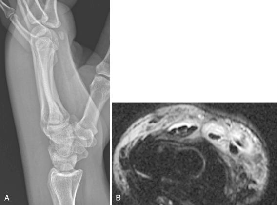 Figure 15.2, Septic tenosynovitis.