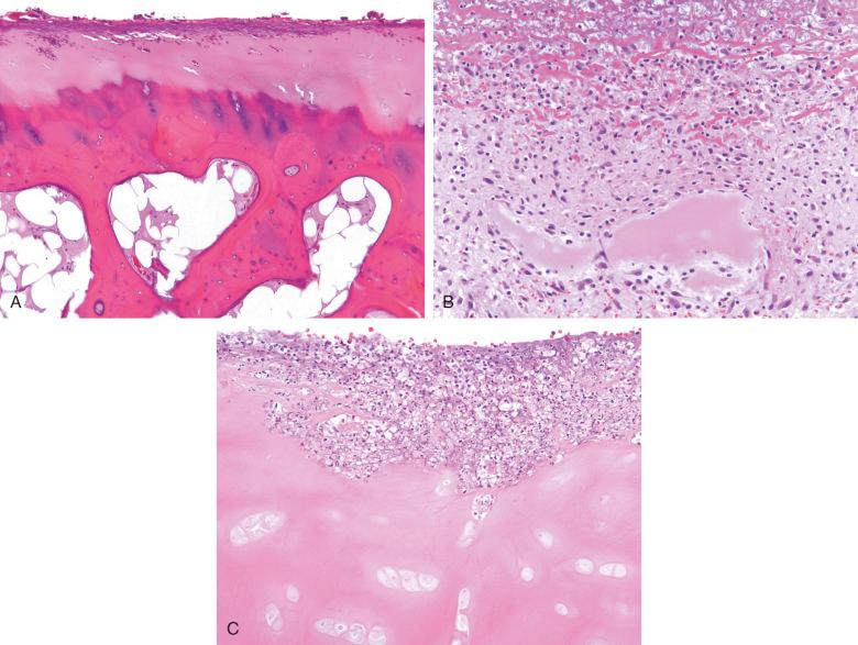 Figure 15.3, Septic arthritis.