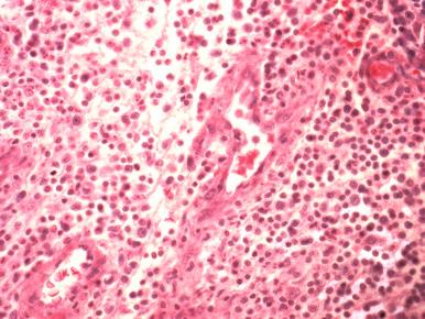 Figure 15.5, Gonococcus causes a periarticular inflammation with granulation tissue, neutrophils, and mononuclear cells.