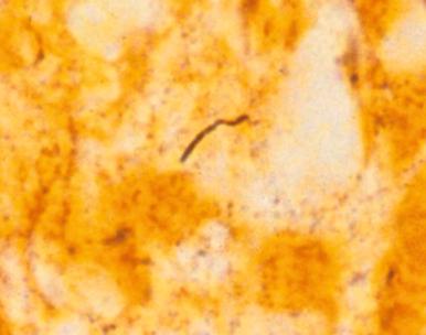 Figure 15.6, Lyme disease with Warthin-Starry stain demonstrating coiled Borrelia burgdorferi spirochete .