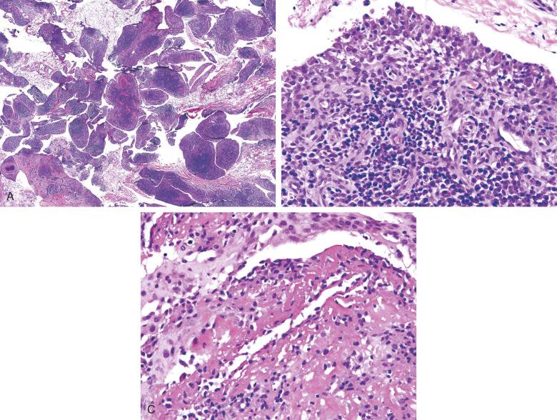 Figure 15.7, Lyme disease.