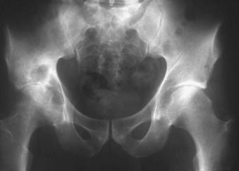 Figure 15.8, Anteroposterior radiograph of the pelvis showing tuberculous arthritis of the right hip. There is mild narrowing of the joint space, and round lucencies are seen in the femoral head and acetabulum. Sclerosis surrounds the lytic foci.