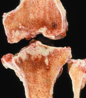 Figure 15.9, Gross specimen of tuberculous arthritis involving the knee. The articular cartilage is eroded, and caseous necrotic tissue has infiltrated into the subchondral bone of the distal femur and the proximal tibia and fibula.