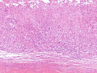 Figure 15.10, Atypical mycobacterial bursitis.