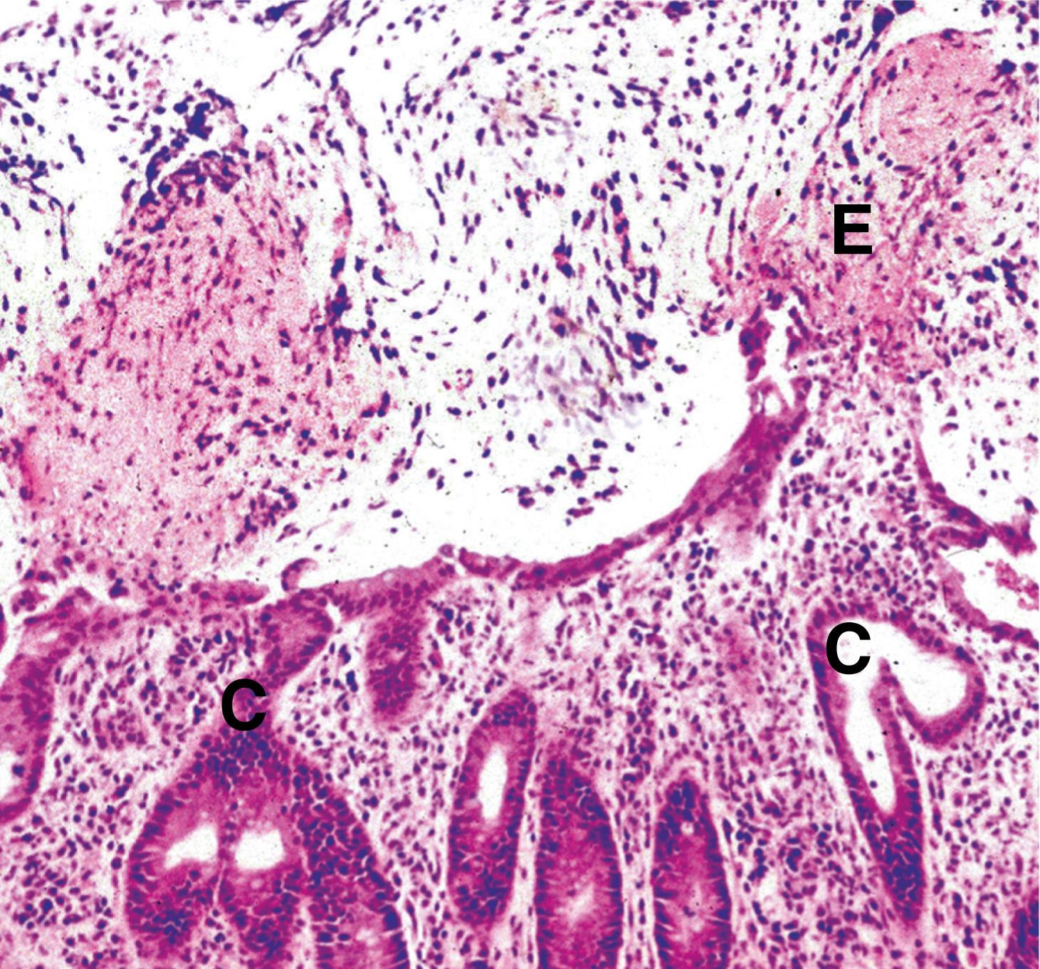 Fig. 5.1, Pseudomembranous colitis.