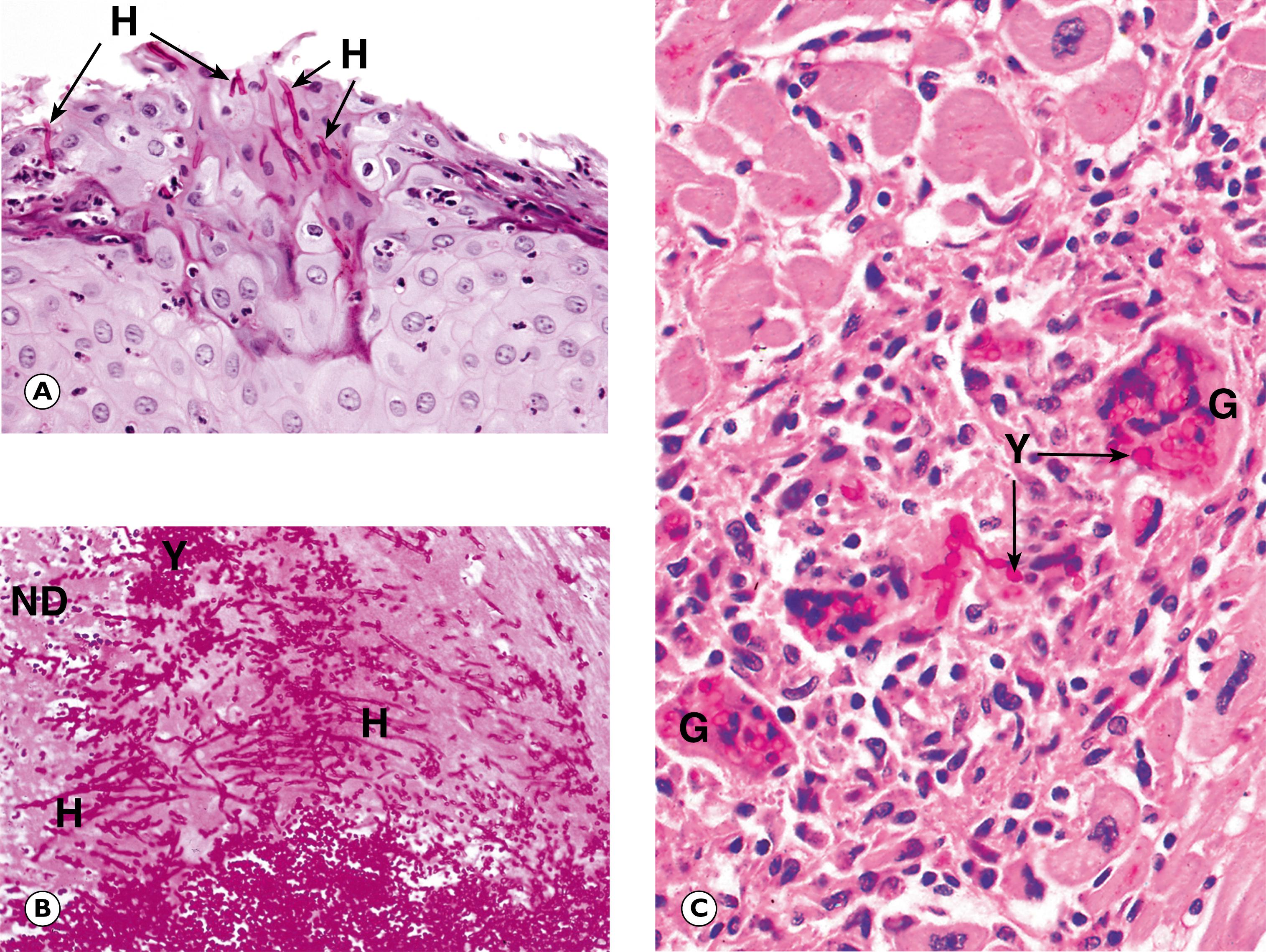 Fig. 5.15, Candidiasis. (A) Oral candidiasis (PAS) (HP); (B) oesophageal candidiasis (PAS) (HP); (C) myocardial candidiasis (PAS) (HP).