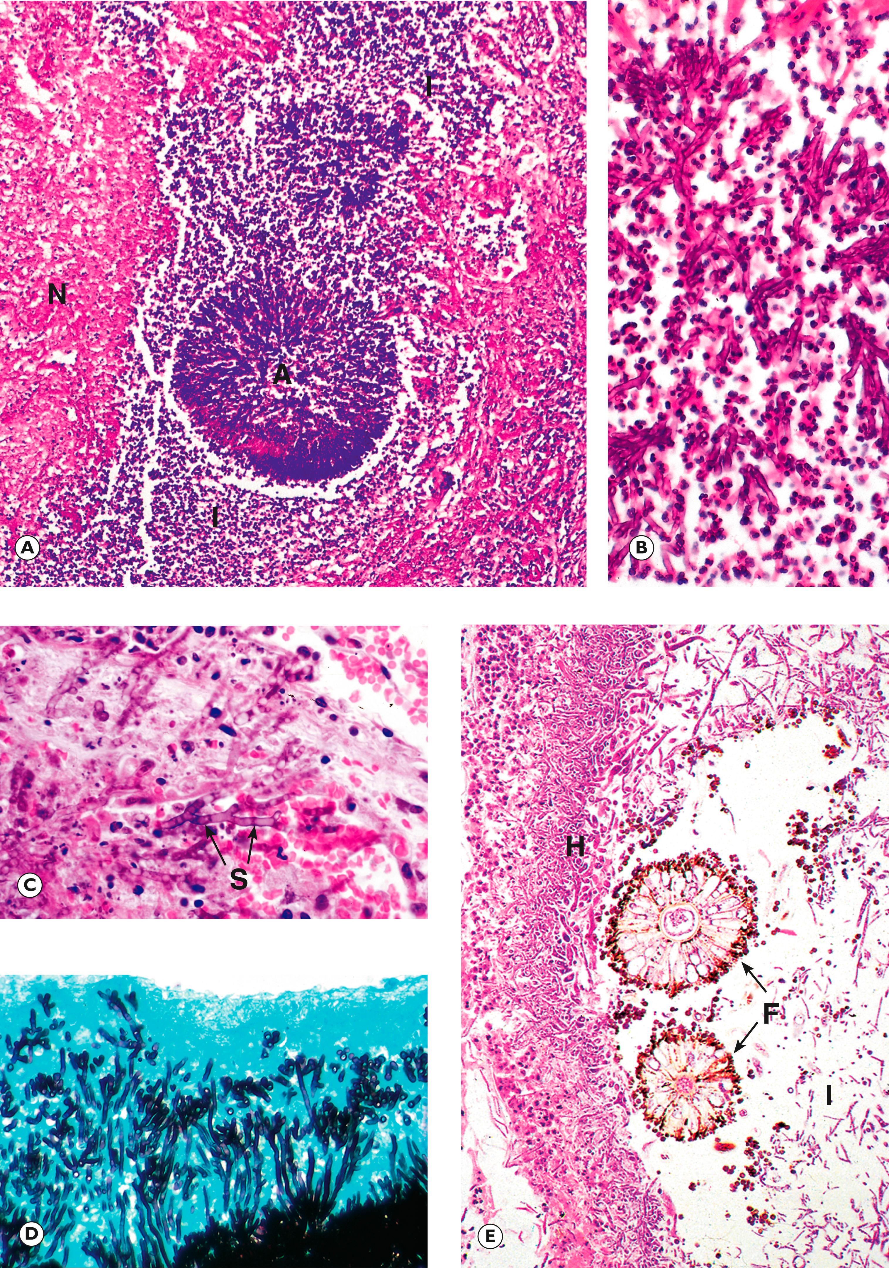 Fig. 5.16, Aspergillus . (A) MP; (B) HP; (C) HP; (D) silver stain (HP); (E) Aspergillus niger (MP).