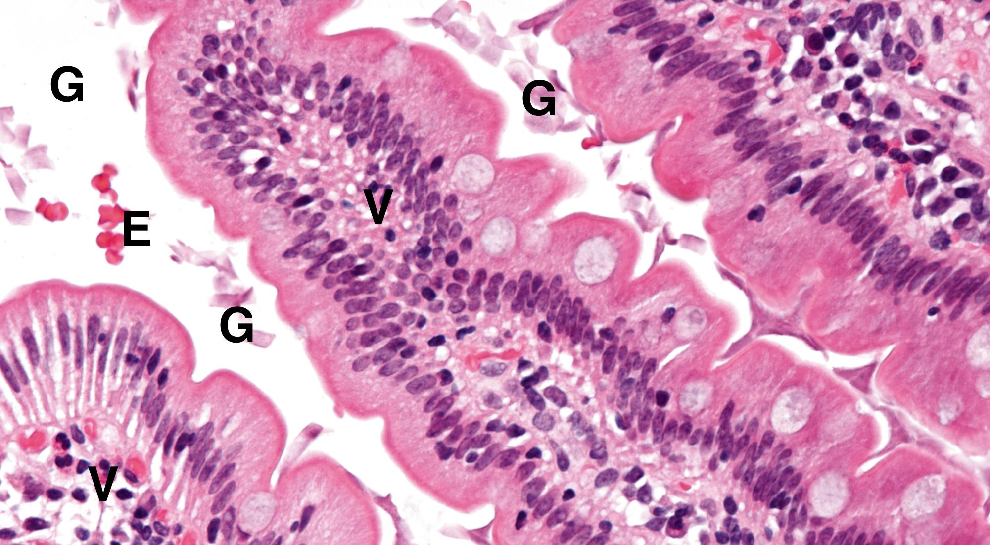 Fig. 5.19, Giardiasis (HP).