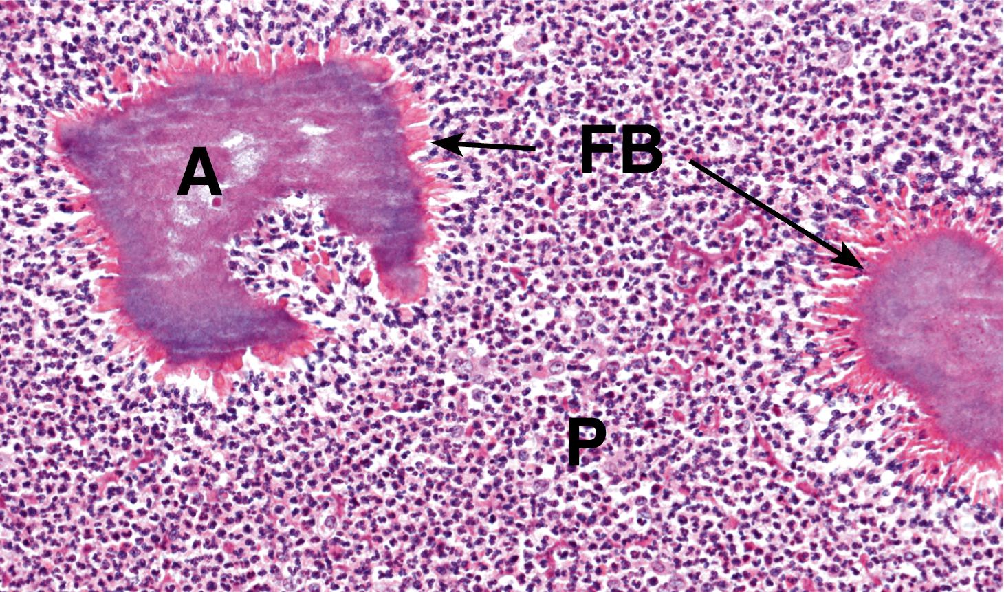 Fig. 5.2, Actinomyces organisms.