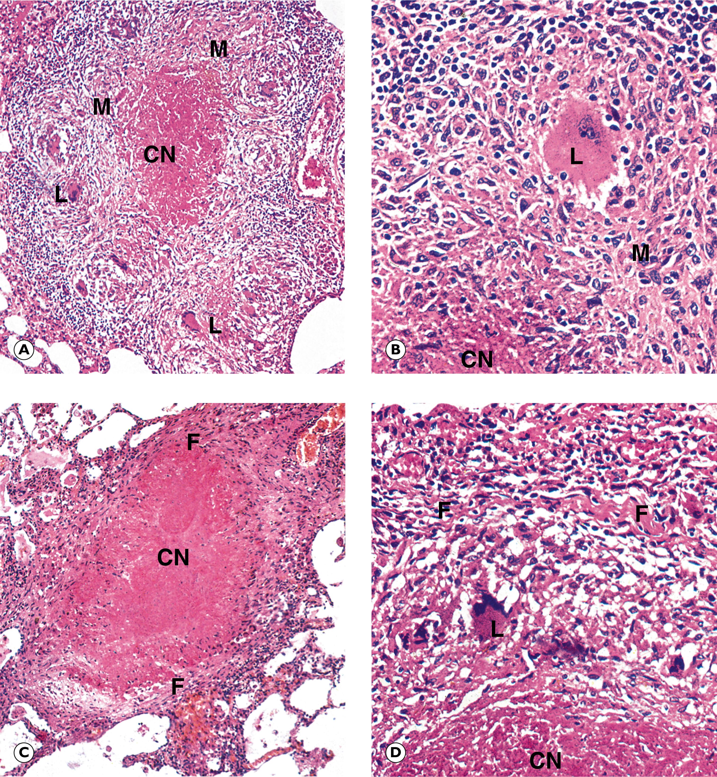 Fig. 5.3, Early pulmonary tuberculosis. (A) Early tubercle (MP); (B) early tubercle (HP); (C) later tubercle (MP); (D) later tubercle (HP).