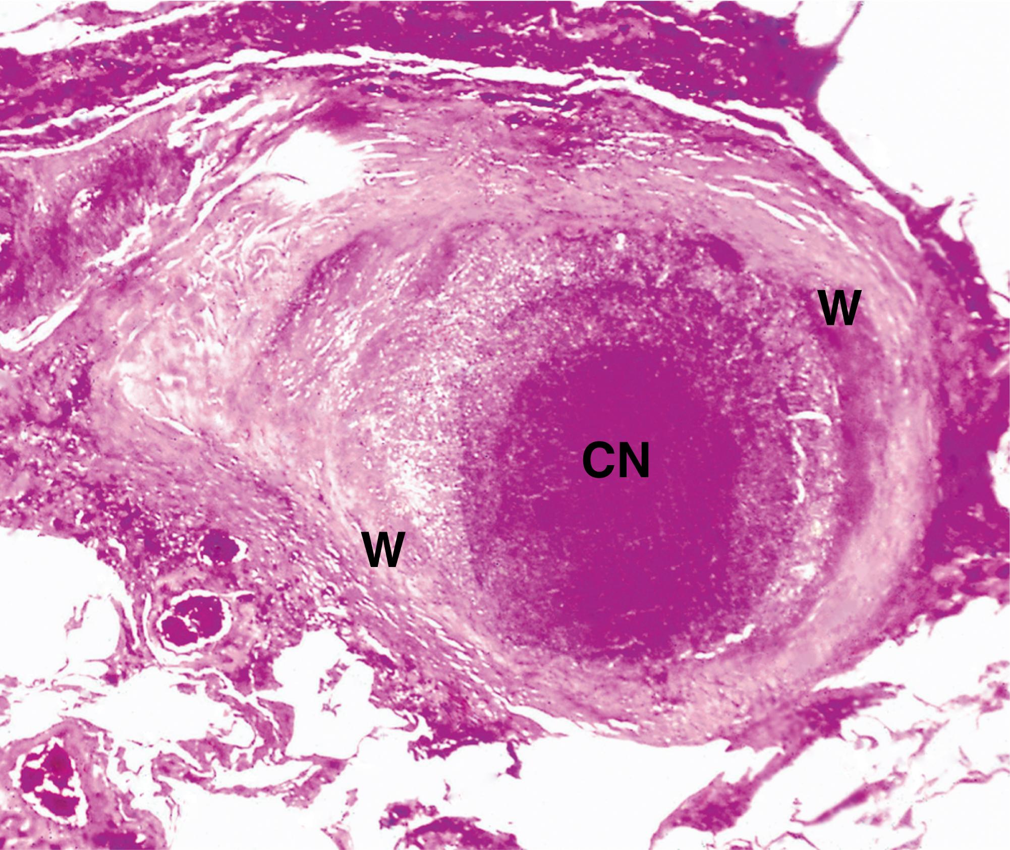 Fig. 5.4, Fibrocaseous tuberculous nodule (LP).