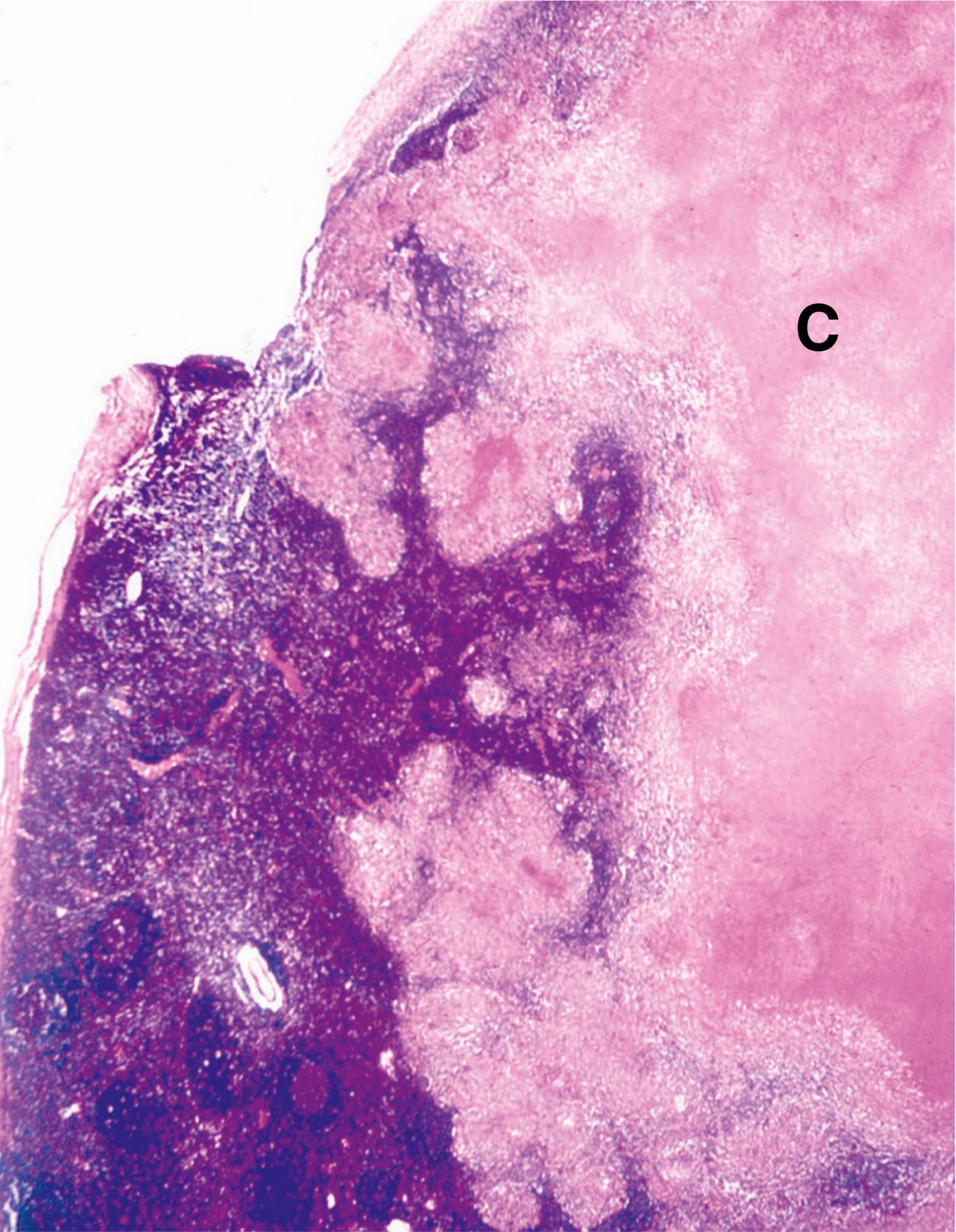 Fig. 5.5, Tuberculous lymph node (LP).