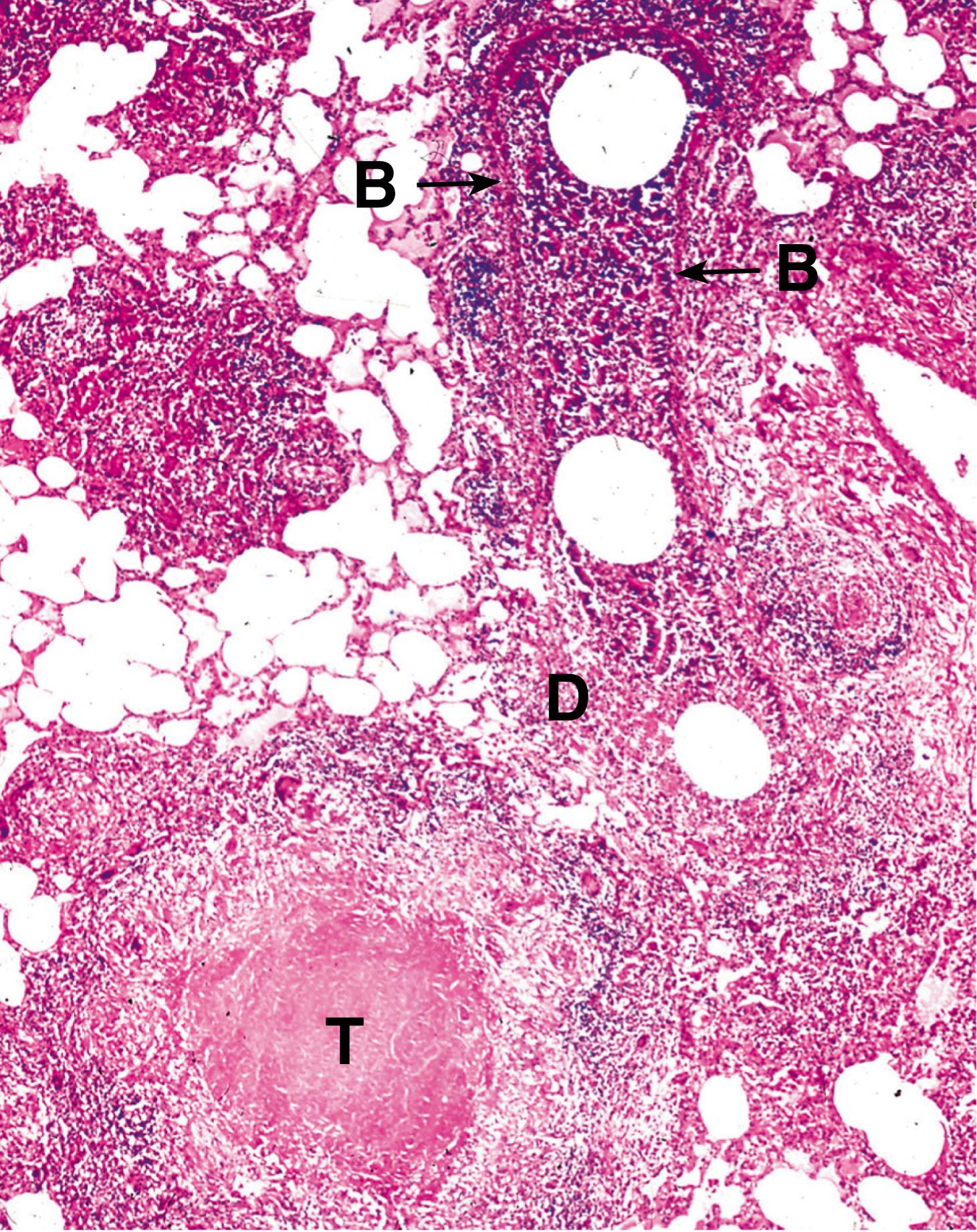 Fig. 5.6, Tuberculous bronchopneumonia (MP).