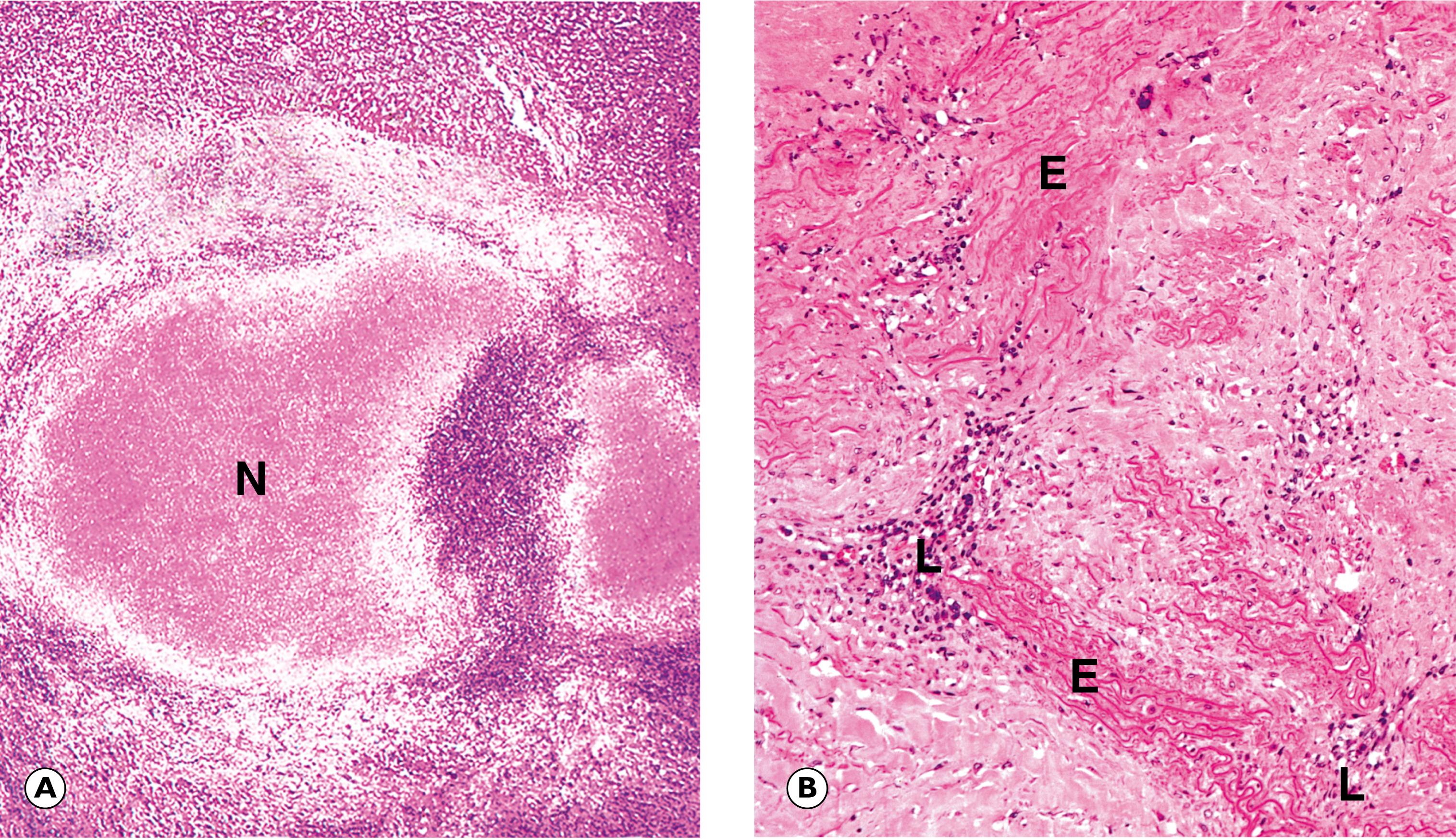 Fig. 5.11, Syphilis. (A) Syphilitic gumma of the liver (LP); (B) syphilitic aortitis (MP).