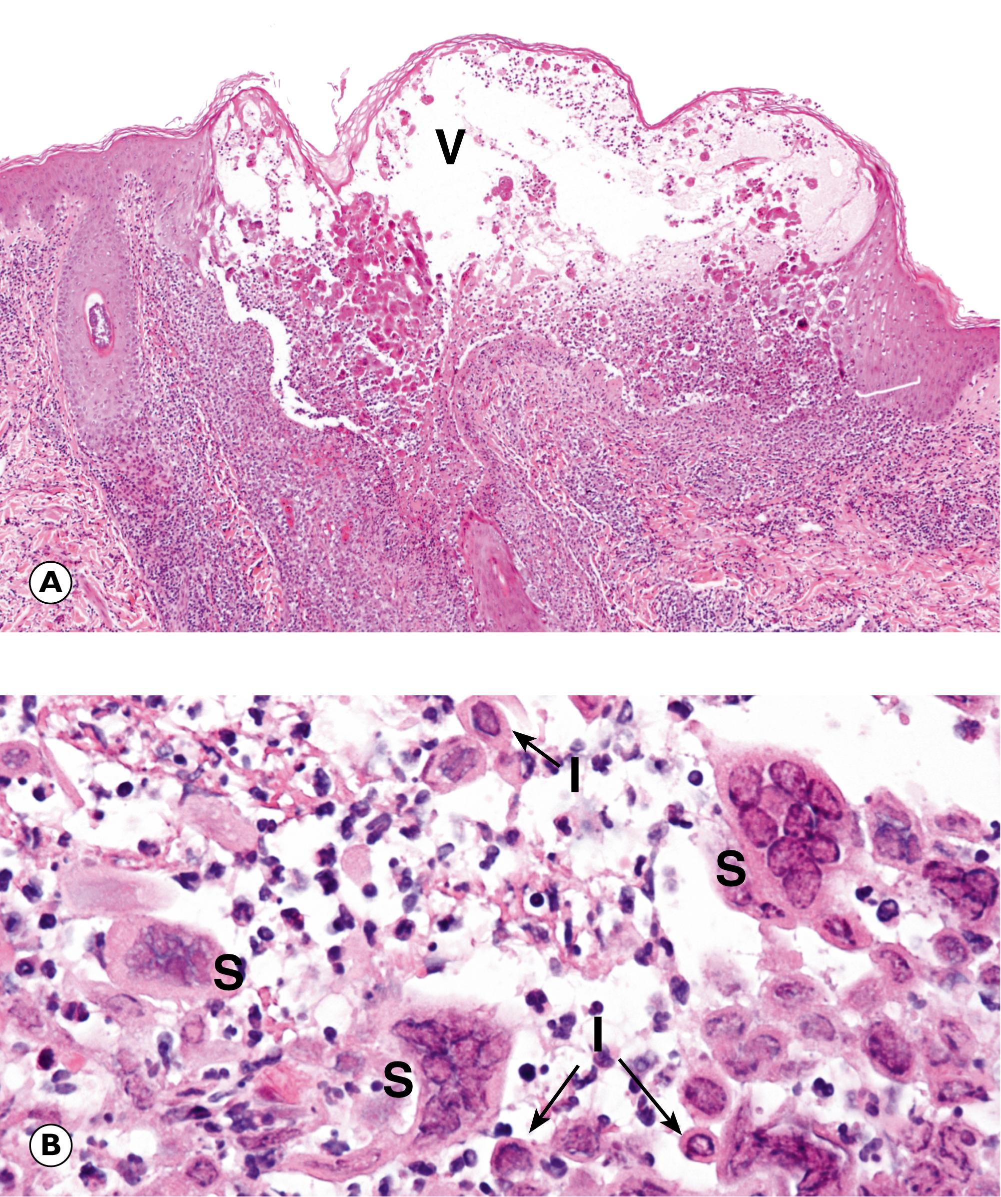 Fig. 5.12, Herpes virus infection. (A) Skin (LP); (B) oesophagus (HP).