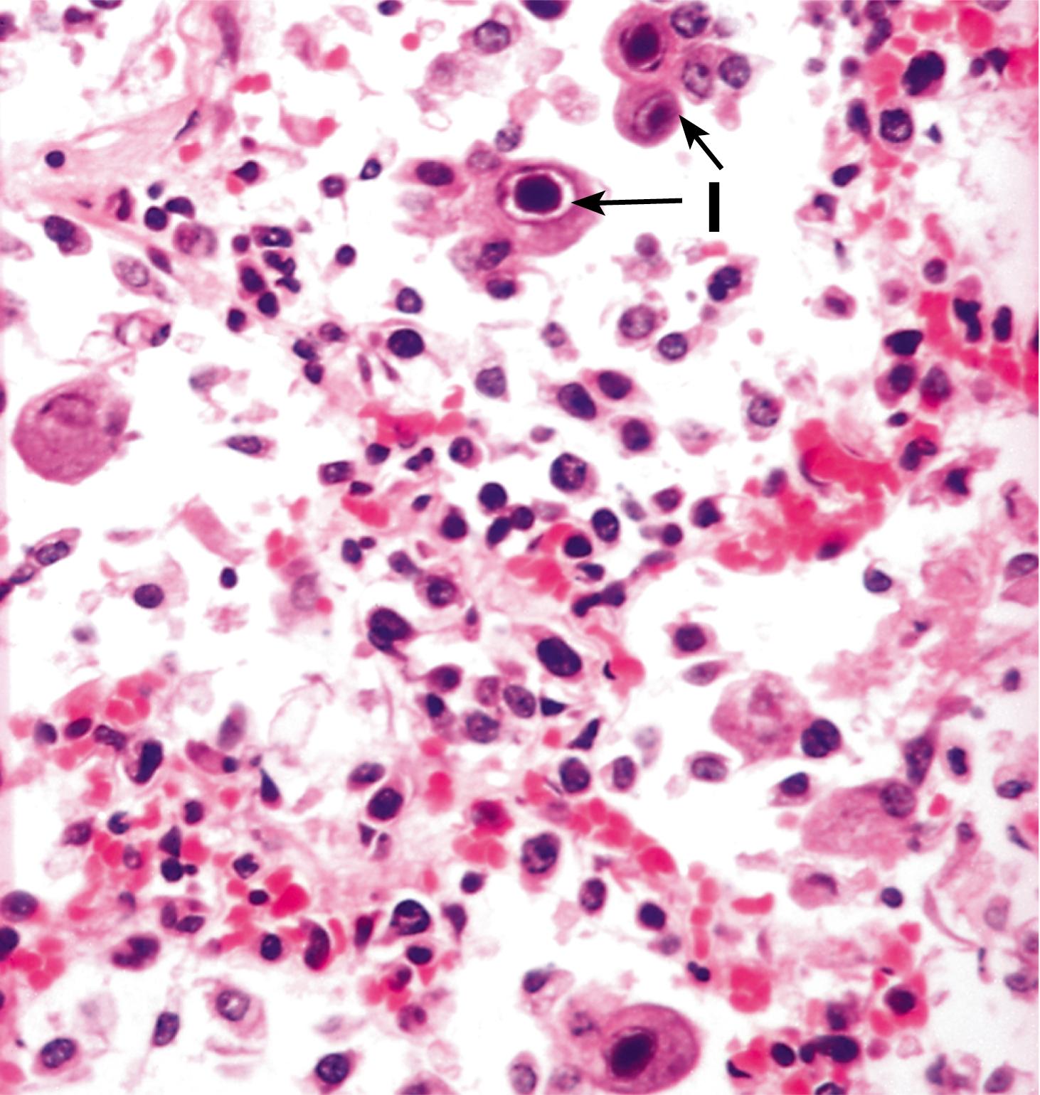 Fig. 5.13, Cytomegalovirus infection (HP).