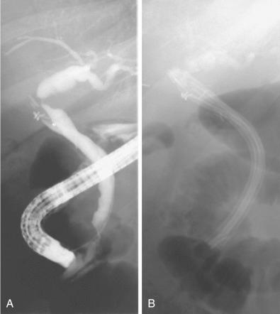 FIG 55.2, A and B, Patient with cholangitis resulting from a benign postoperative bile duct stricture shown by endoscopic retrograde cholangiopancreatography (ERCP) ( A ) and after placement of three 10-Fr plastic stents ( B ).