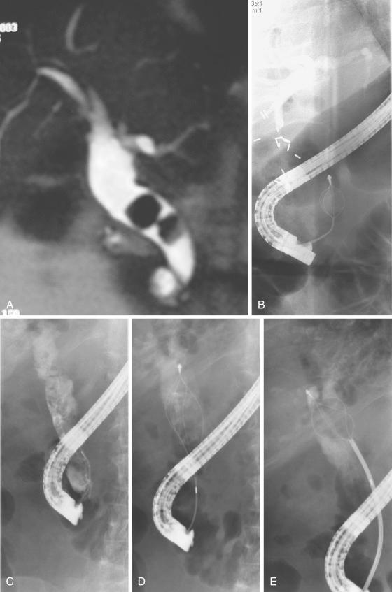 FIG 55.4, A, Magnetic resonance cholangiopancreatography (MRCP) shows two large bile duct stones in a patient with cholangitis. B, Endoscopic retrograde cholangiopancreatography (ERCP) in the same patient with basket extraction of one of the stones. C, ERCP shows dilated bile duct packed with stones. D, Basket extraction. E, Mechanical lithotripsy.