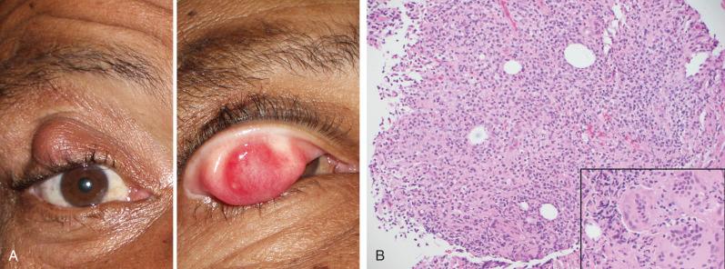 Figure 21.1, Chalazion.