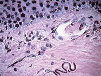 Figure 21.14, Onchocerciasis. An intact microfilaria is seen in the substantia propria at the corneal limbus with mild surrounding inflammatory reaction (×400).