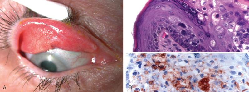 Figure 21.2, Intraepithelial sebaceous carcinoma mimicking unilateral infectious blepharoconjunctivitis.