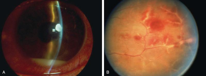 Figure 21.4, Behçet disease.