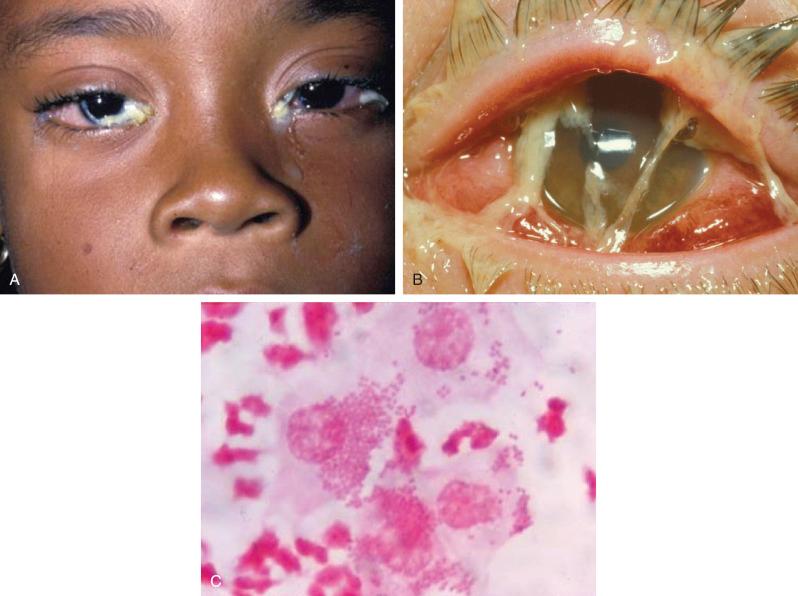 Figure 21.6, Bacterial conjunctivitis.