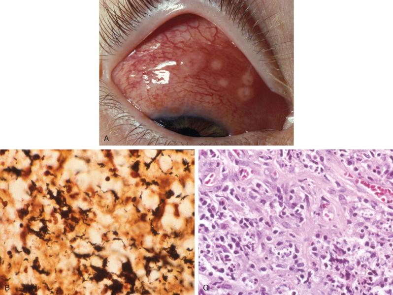 Figure 21.8, Cat-scratch disease.