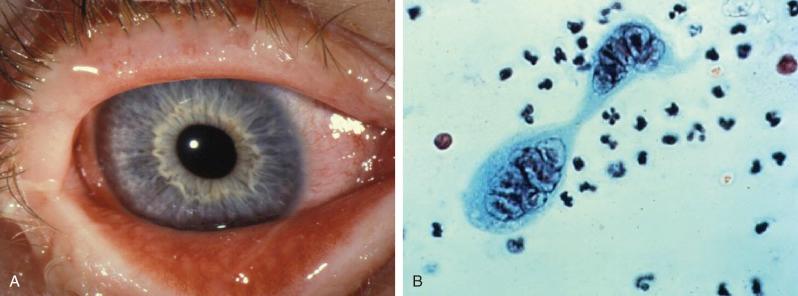 Figure 21.10, Herpes simplex conjunctivitis.