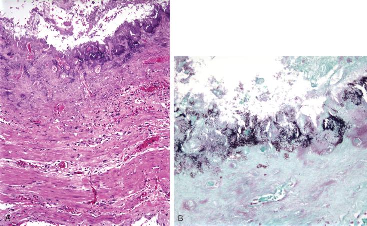 Figure 10.1, Nonspecific bacterial esophagitis.