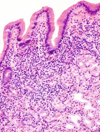 Figure 10.11, Helicobacter pylori infection.