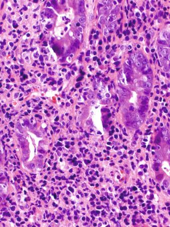 Figure 10.12, Helicobacter pylori gastritis.