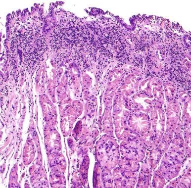 Figure 10.13, Helicobacter pylori infection of fundic mucosa.